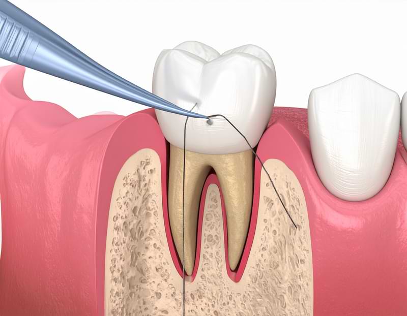 kök ucu rezeksiyonu