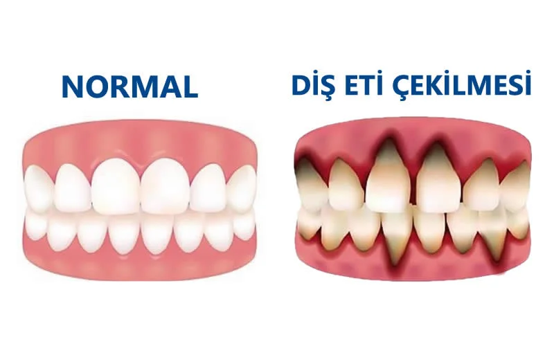 diş eti çekilmesi nedenleri 