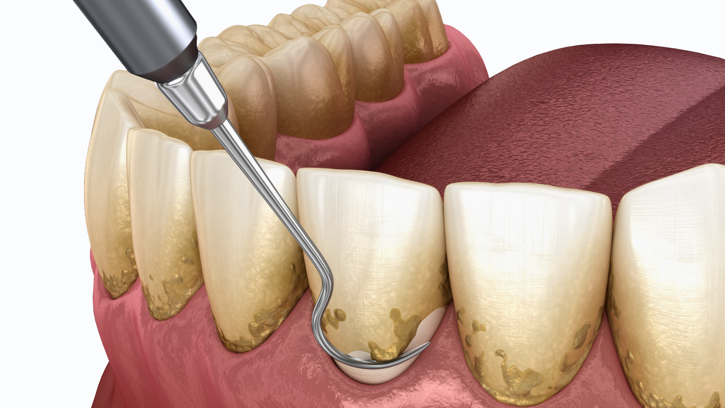periodontal tedavi 